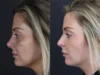 Facial Filler case #8818 slider thumbnail