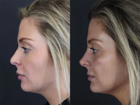 Facial Filler case #8818