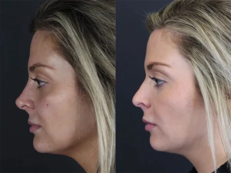 Facial Filler case #8818