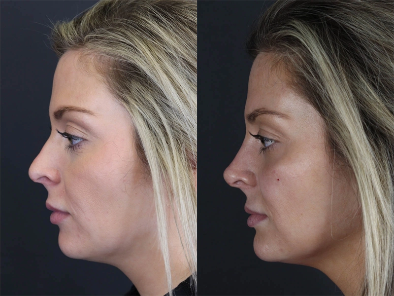 Facial Filler case #8818