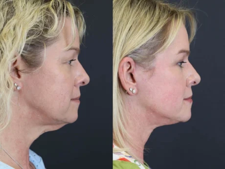 Facelift case #8959
