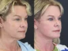 Facelift case #8959 slider thumbnail