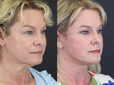 Facelift case #8959