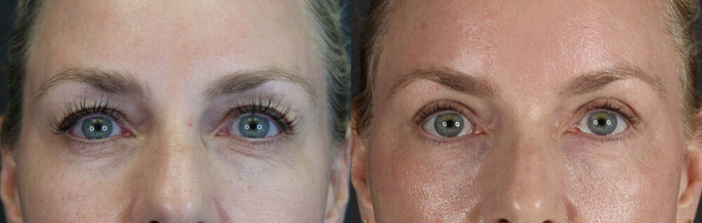 Blepharoplasty case #8950
