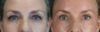 Blepharoplasty case #8950 slider thumbnail