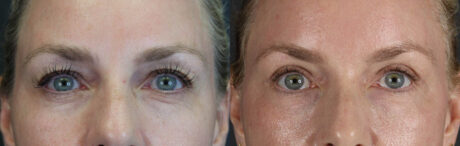 Blepharoplasty case #8950