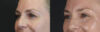 Blepharoplasty case #8950 slider thumbnail