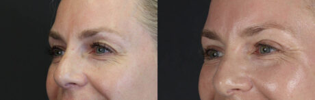 Blepharoplasty case #8950