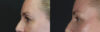 Blepharoplasty case #8950 slider thumbnail