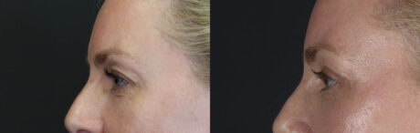 Blepharoplasty case #8950