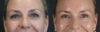 Blepharoplasty case #8950 slider thumbnail