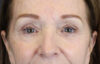 Brow Lift case #9750