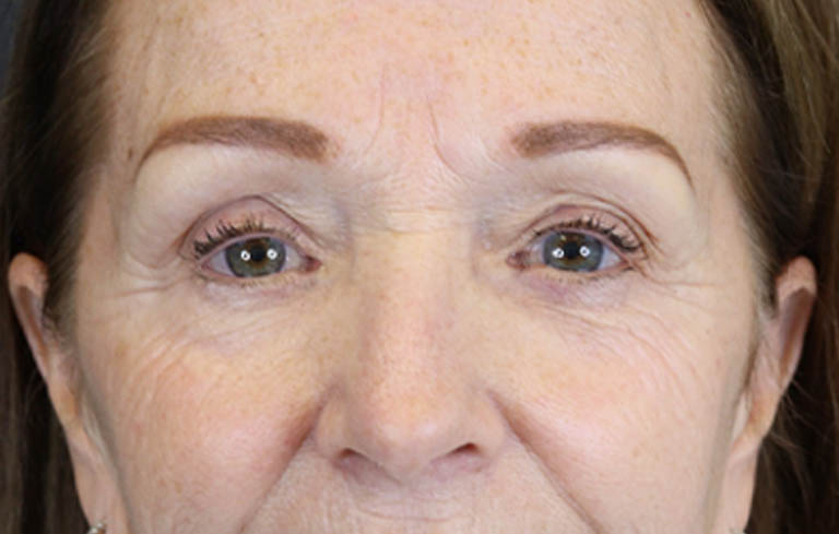 Brow Lift case #9750