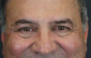 Blepharoplasty case #9598