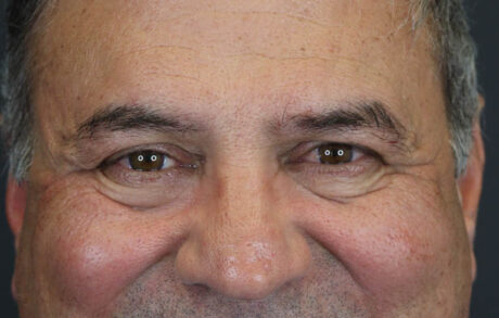 Blepharoplasty case #9598