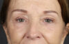 Brow Lift case #9750