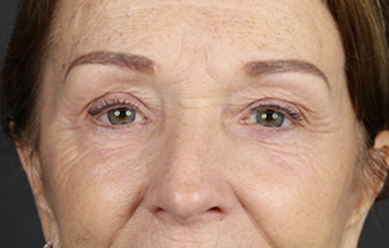 Brow Lift case #9750