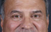 Blepharoplasty case #9598