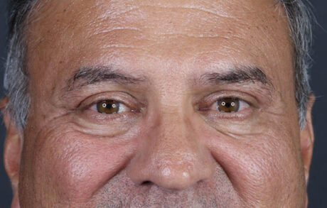Blepharoplasty case #9598