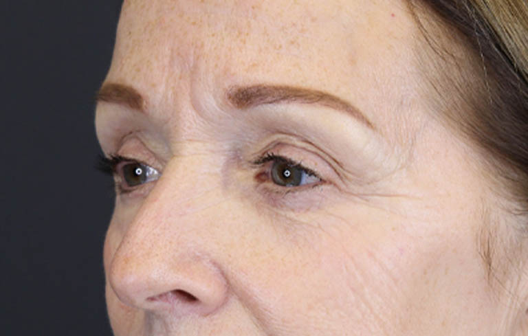 Brow Lift case #9750