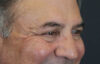 Blepharoplasty case #9598