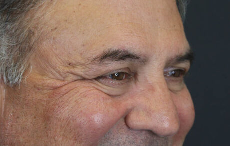 Blepharoplasty case #9598