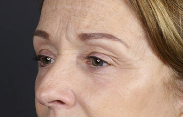 Brow Lift case #9750
