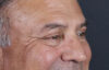 Blepharoplasty case #9598