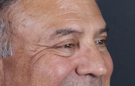 Blepharoplasty case #9598