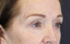 Brow Lift case #9750