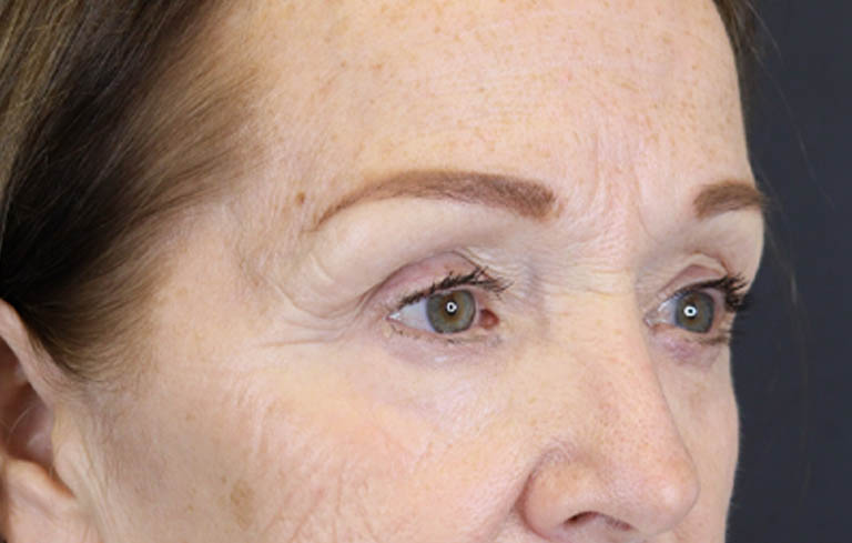 Brow Lift case #9750