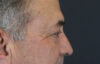 Blepharoplasty case #9598
