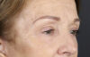 Brow Lift case #9750
