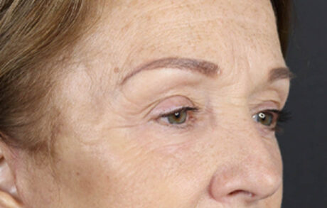 Brow Lift case #9750