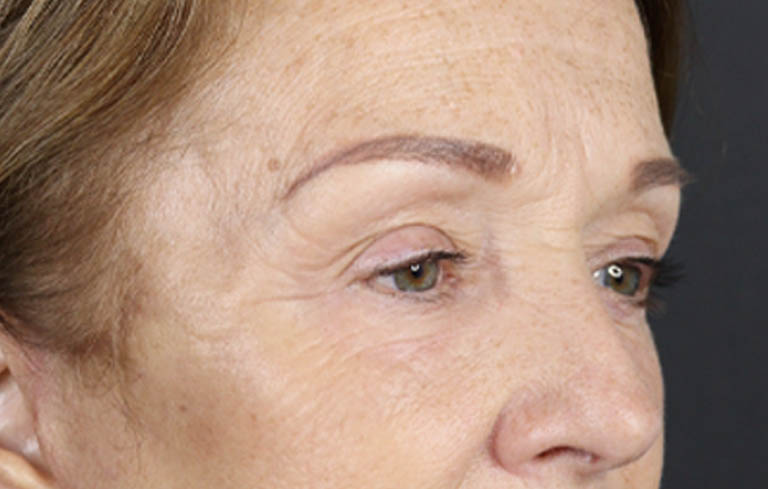 Brow Lift case #9750