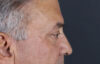 Blepharoplasty case #9598