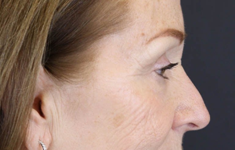 Brow Lift case #9750