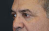 Blepharoplasty case #9598