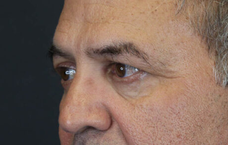 Blepharoplasty case #9598