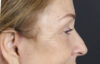 Brow Lift case #9750