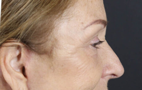 Brow Lift case #9750