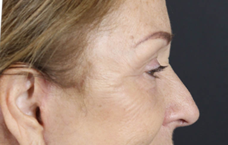 Brow Lift case #9750