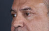 Blepharoplasty case #9598