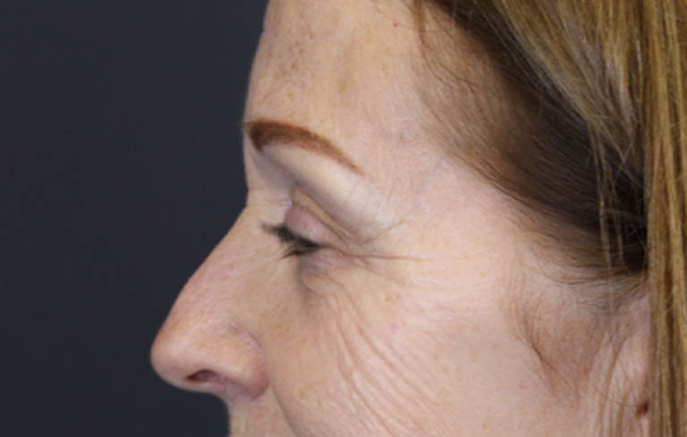 Brow Lift case #9750