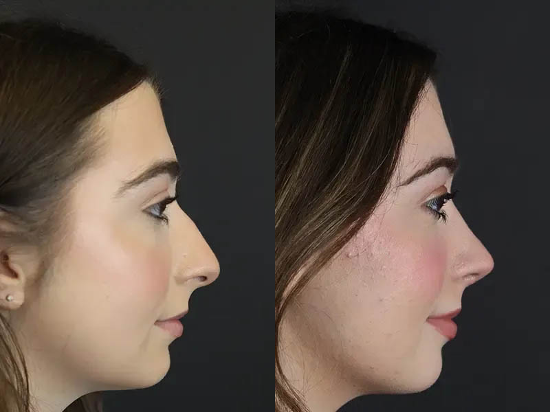 Rhinoplasty case #9650