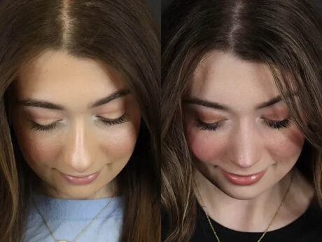 Rhinoplasty case #9650