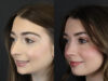 Rhinoplasty case #9650 slider thumbnail