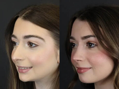 Rhinoplasty case #9650