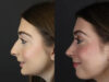 Rhinoplasty case #9650 slider thumbnail