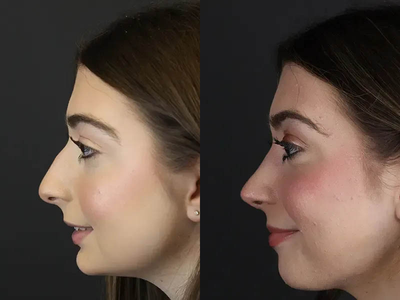 Rhinoplasty case #9650